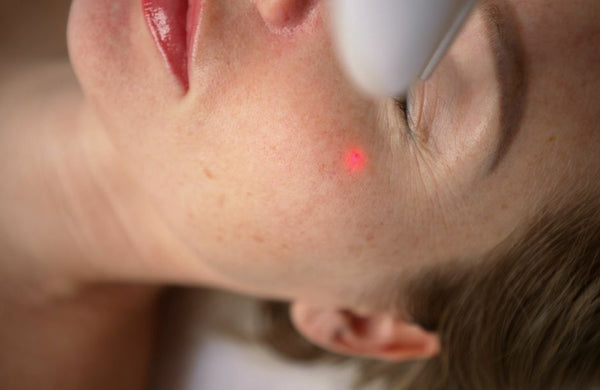 The 5 Best Cosmetic Surgery Lasers Available